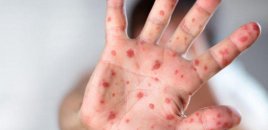 Azərbaycanda qızılca və suçiçəyi ilə bağlı epidemioloji vəziyyət necədir?