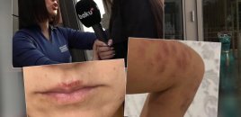 Bakıda salonda qadını lazer edərkən yandırdılar - İDDİA