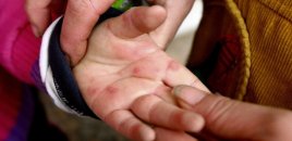 Ayaq və əllərdə göbələk varsa, bunu edin