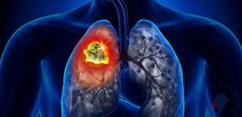 Ağciyər xərçənginə qarşı peyvənd hazırlandı - İnsanlar üzərində yoxlanılacaq