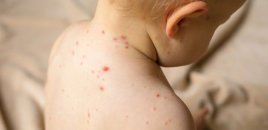 Son günlər çoxalan suçiçəyi xəstəliyi kütləvi hal alıb? - VİDEO