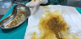 Həkimə qarın ağrısı ilə getdi - rekord sayda öd daşı aşkarlandı