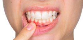 Stressin yaratdığı problem: Diş qıcama nələrə yol aça bilər?