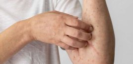 Qızılca və suçiçəyinə yoluxanların sayı açıqlandı - RƏSMİ