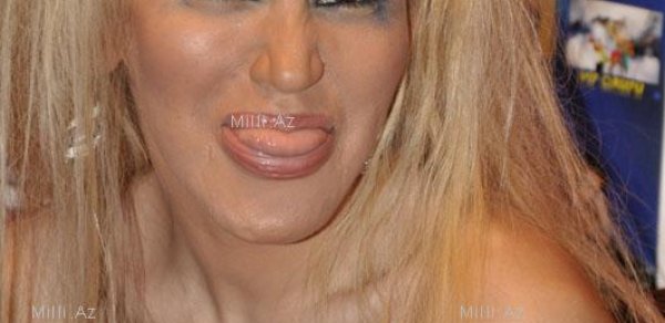 Plastik əməliyyatdan sonra Rəqsanə (FOTO)