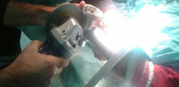 Azərbaycanda 5 yaşlı qızın əlini ət maşını doğradı