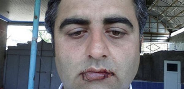 Azərbaycanda kişi evinin pulunu ala bilmədiyi üçün ağzını tikdi -  FOTO 