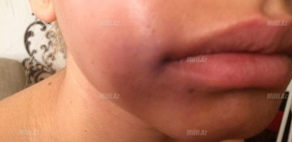 Bakıda məşhur idmançı gecə klubunda qız döydü – FOTO