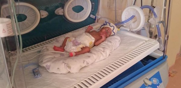 650 qram çəkidə doğulan uşaq xilas edildi- FOTO