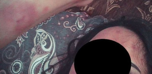 Hamilə sevgilisini ütü ilə yandıran kişi həbs edildi - Rəsmi açıqlama