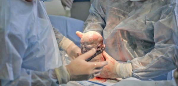 Bakıda 22 yaşlı ana doğuş zamanı öldü