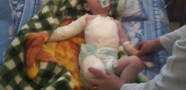 Azərbaycanda 1 yaşlı uşaq qaynar suda yandı