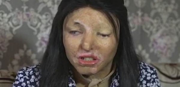Rəfiqəsinin üzünü “kislota” ilə yandırıb Azərbaycana qaçdı - Xəyanətin qisasını alıb