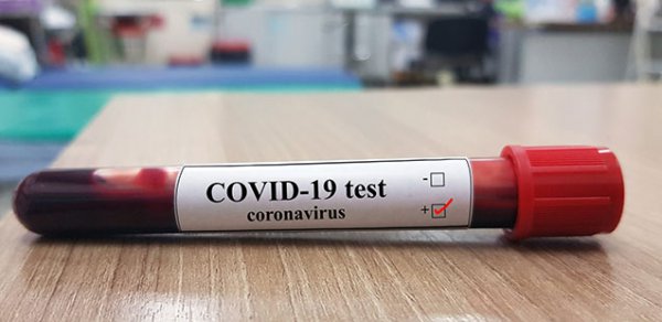 Azərbaycanda daha 105 nəfər koronavirusa yoluxdu,  360 nəfər sağaldı