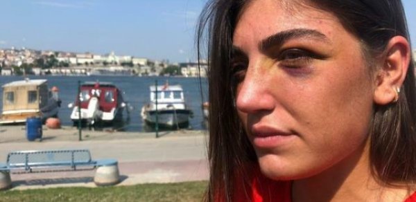 Gecə klubuna gedən modeli sevgilisi döydü, burnunu qırdı - VİDEO 