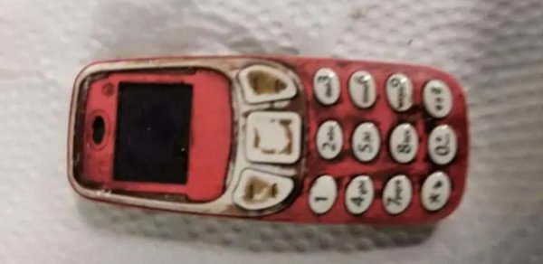 Əməliyyat olunan şəxsin mədəsindən “Nokia” çıxdı - FOTO