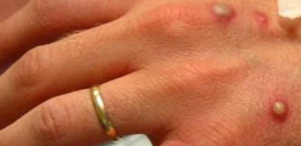 Bu ölkədə 80% insan "meymun çiçəyi"nə qarşı peyvəndlənib