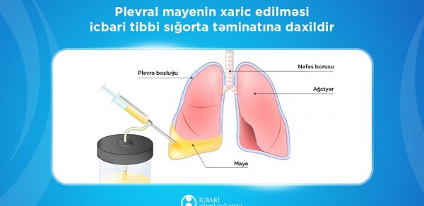 Ağciyərlərə yığılmış mayenin çəkilməsi məqsədilə 5643 prosedur icra olundu