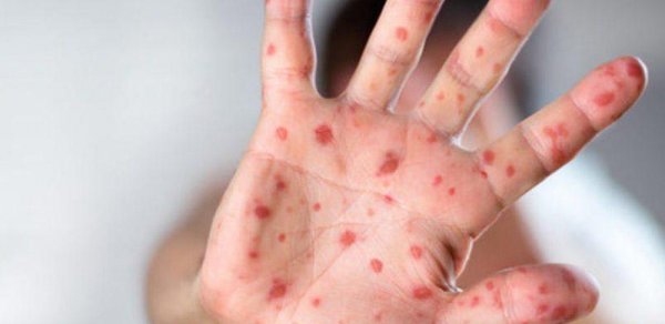 Azərbaycanda qızılca və suçiçəyi ilə bağlı epidemioloji vəziyyət necədir?