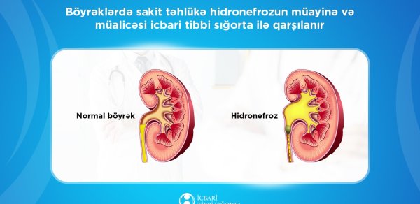 Hidronefrozun müayinə və müalicəsi icbari tibbi sığorta ilə qarşılanır
