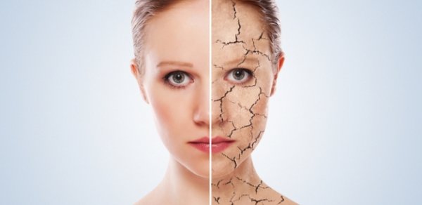 Soyuq havada quru dəri problemindən necə xilas olaq?