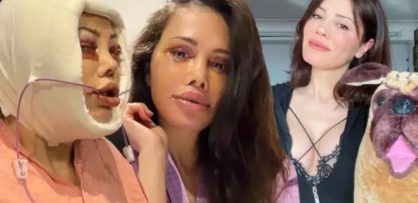 Üz nəqli etdirən fenomen xərçəng oldu