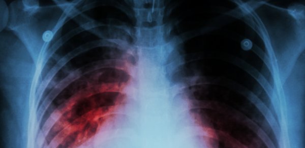 Ötən il 198 uşaq və yeniyetmə vərəmə yoluxub