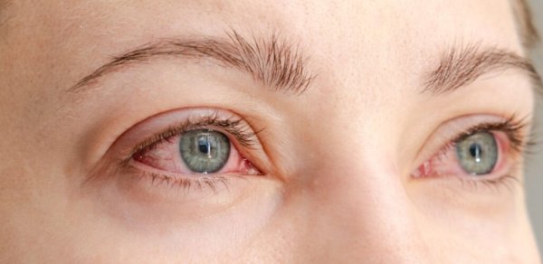 Allergiya mövsümü başladı: Gözlərinizin qorunma yolları