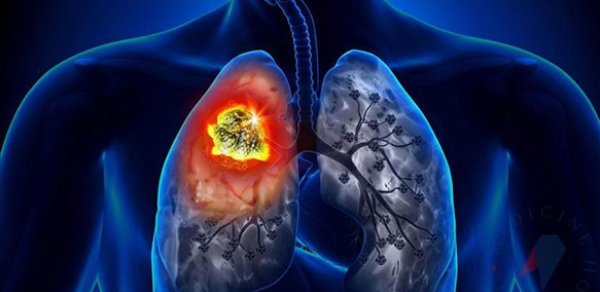 Ağciyər xərçənginə qarşı peyvənd hazırlandı - İnsanlar üzərində yoxlanılacaq