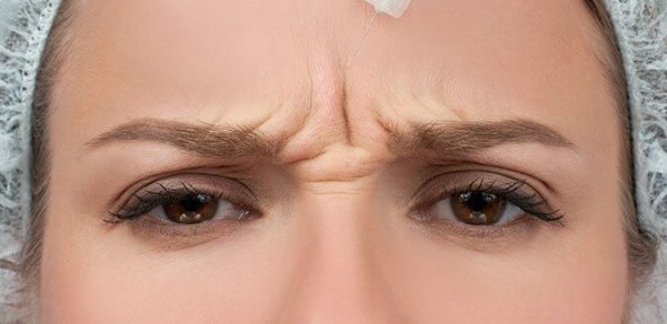 Botoksdan sonra arzuolunmaz nəticələr yaranarsa nə etməli? – Həkimlərdən tövsiyə