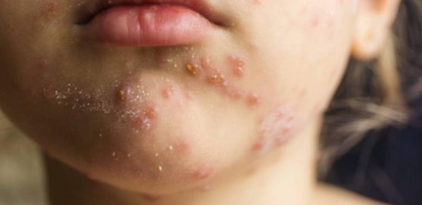 Banqladeşdə qızılca epidemiyası dərinləşir: Ölən uşaqların sayı 712-yə çatdı