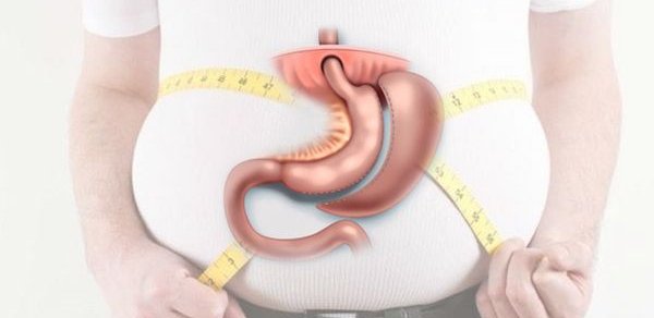 Çəki gedir, bəs sağlamlıq? – Mədəkiçiltmə əməliyyatının təhlükəli tərəfləri