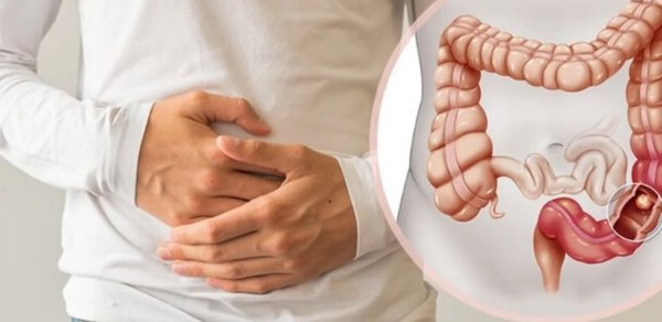 Həkimdən həyacan təbili: Bağırsaq xərçəngi gəncləşir