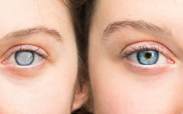 Katarakta nədir? - Əlamətləri və müalicəsi haqda bilmədikləriniz