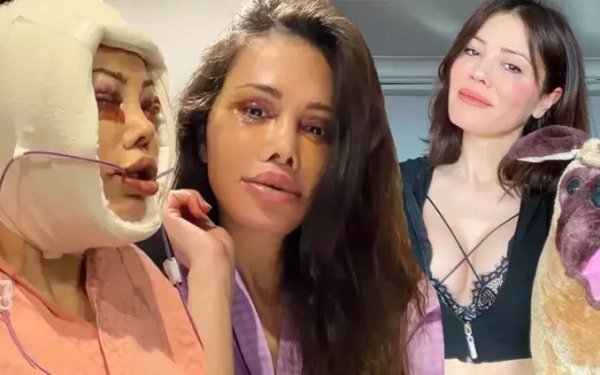 Üz nəqli etdirən fenomen xərçəng oldu