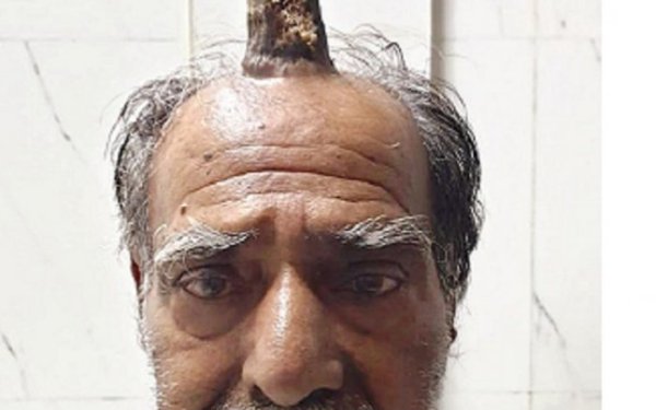 74 yaşlı kişinin başında “buynuz" çıxdı - FOTO