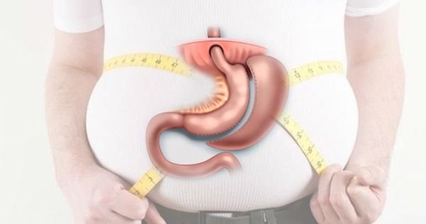 Çəki gedir, bəs sağlamlıq? – Mədəkiçiltmə əməliyyatının təhlükəli tərəfləri
