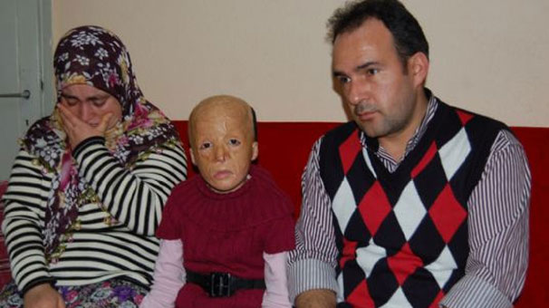 Üzü yanan qız 8 ildə 32 dəfə əməliyyat olundu, 30 dəfə də olacaq - FOTO