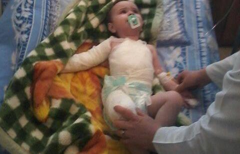 Azərbaycanda 1 yaşlı uşaq qaynar suda yandı