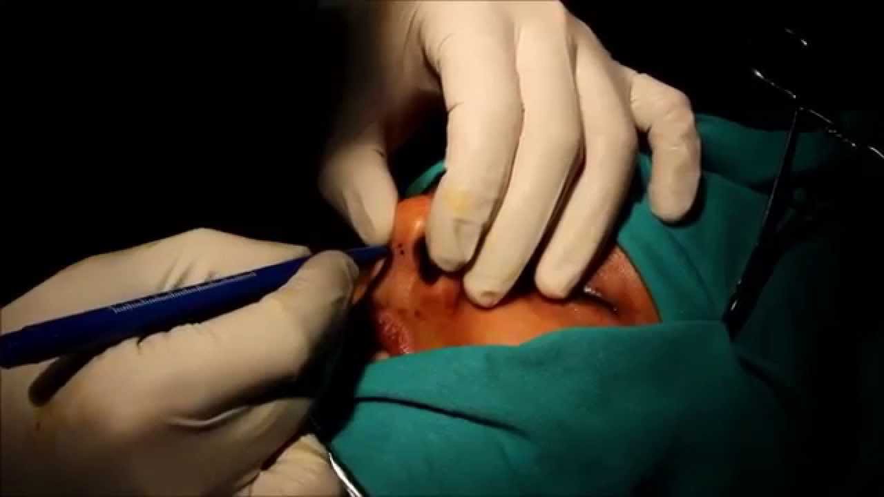 Bakıda burnunu kəsdirən qızdan ŞOK ƏMƏL