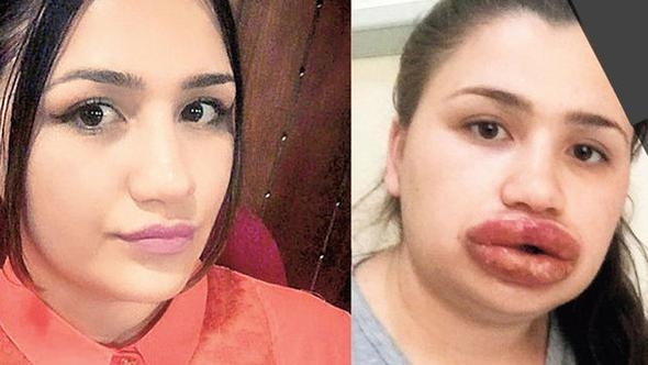 Türk qızın dodaqları Azərbaycanda oxuyan kosmetoloqun qurbanı oldu