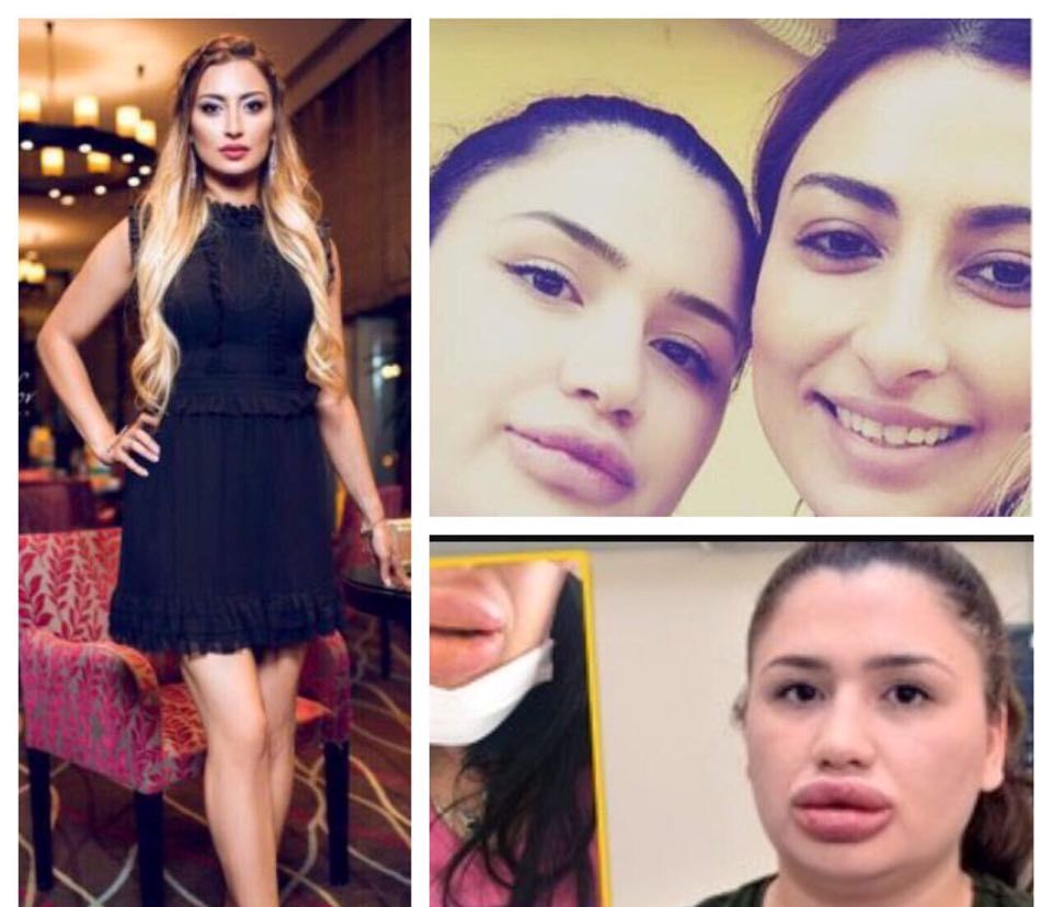Azərbaycanlı kosmetoloq Türkiyəli həkimlərə master klass keçdi – 14 qr silikonu belə yox etdi - FOTOFAKT
