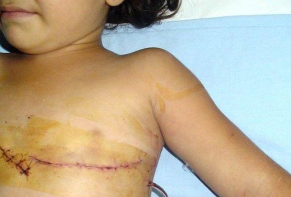 Azərbaycanda 5 yaşlı qızın ürəyinə iynə batdı – FOTO