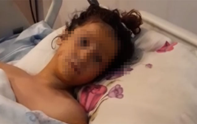 Transformatora girən azyaşlının 2 ayağı və qolu amputasiya edildi