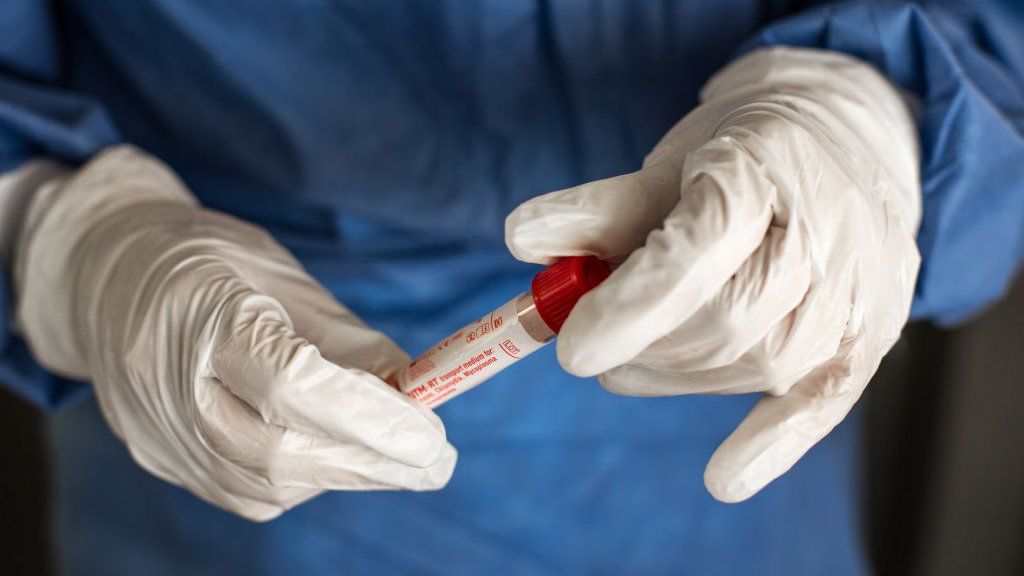 Azərbaycanda 67 nəfərdə koronavirus aşkarlandı, 1 nəfər vəfat etdi