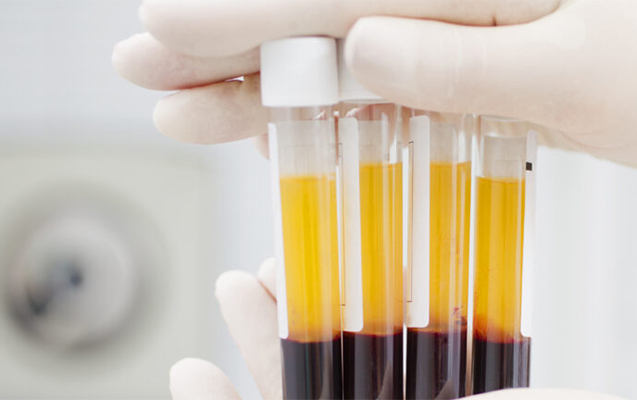 Azərbaycanda daha 50 nəfərdə koronavirus aşkarlandı - 1 nəfər öldü