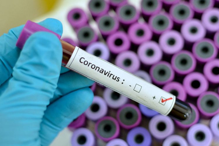 Ermənistanda daha 47 nəfərdə koronavirus aşkarlanıb