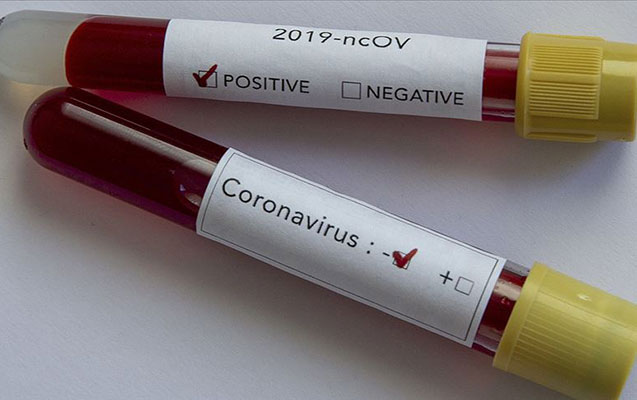 Azərbaycanda daha 28 nəfərdə koronavirus aşkarlandı - 59 nəfər sağaldı