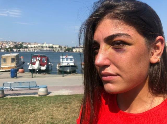 Gecə klubuna gedən modeli sevgilisi döydü, burnunu qırdı - VİDEO 