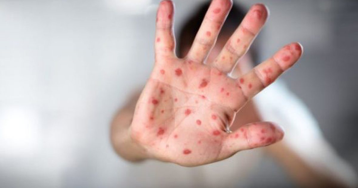 ÜST-dən xəbərdarlıq: Fırtınadan əvvəlki sakitlikdir, daha bir qorxulu epidemiya gəlir